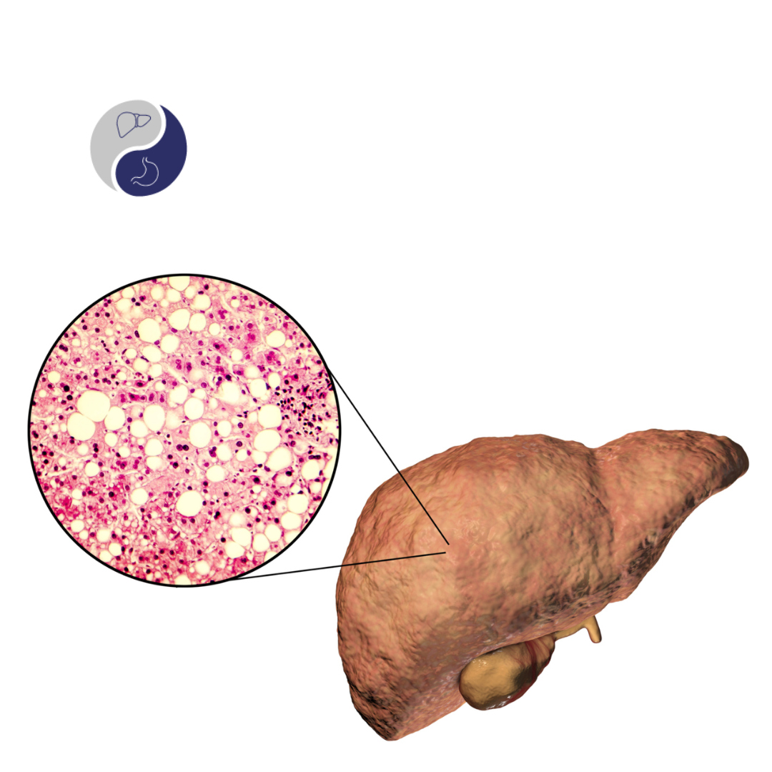 Esteatose Hepática