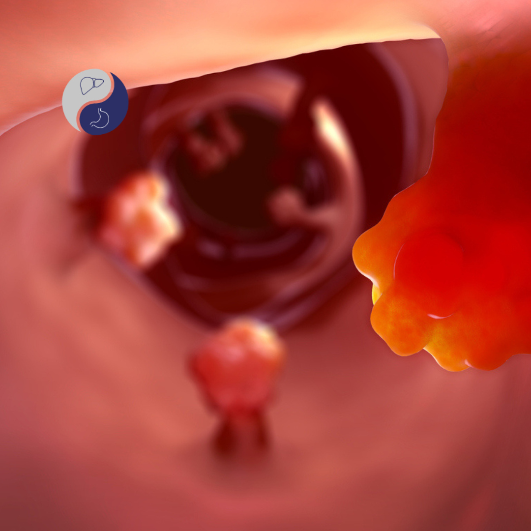 Pólipos de Intestino