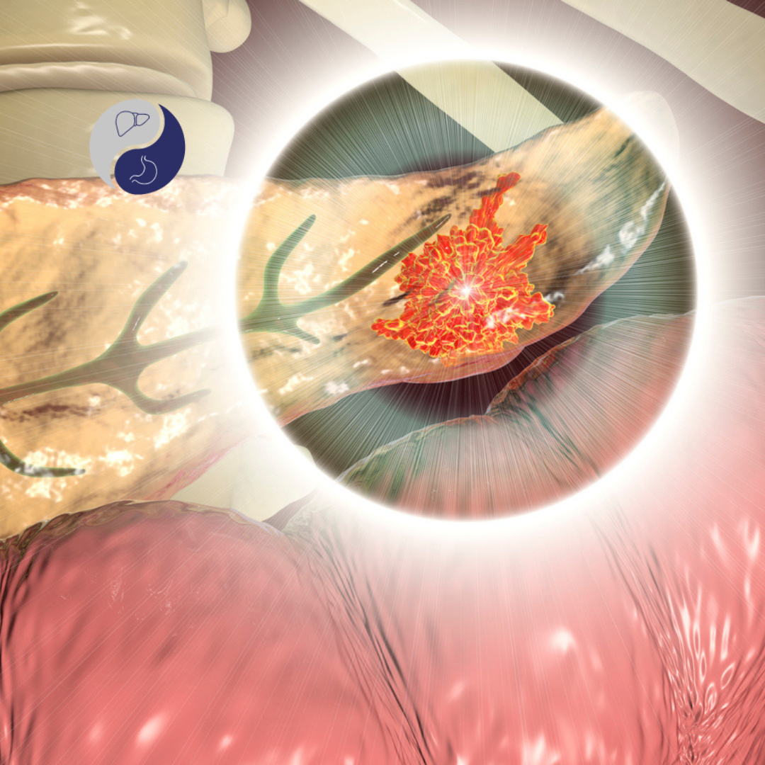 Câncer de Pâncreas